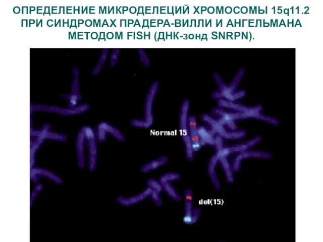 ОПРЕДЕЛЕНИЕ МИКРОДЕЛЕЦИЙ ХРОМОСОМЫ 15q11.2 ПРИ СИНДРОМАХ ПРАДЕРА-ВИЛЛИ И АНГЕЛЬМАНА МЕТОДОМ FISH (ДНК-зонд SNRPN).