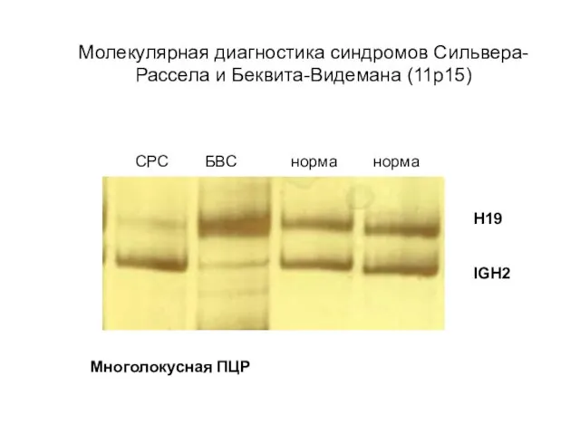 Молекулярная диагностика синдромов Сильвера-Рассела и Беквита-Видемана (11р15) СРС БВС норма норма Н19 IGH2 Многолокусная ПЦР