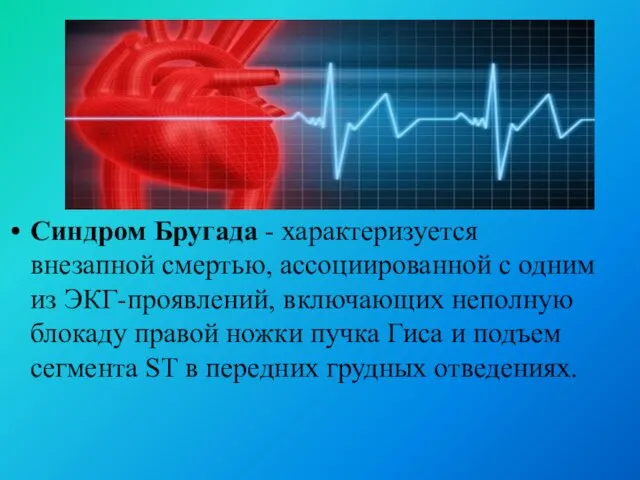 Синдром Бругада - характеризуется внезапной смертью, ассоциированной с одним из ЭКГ-проявлений,