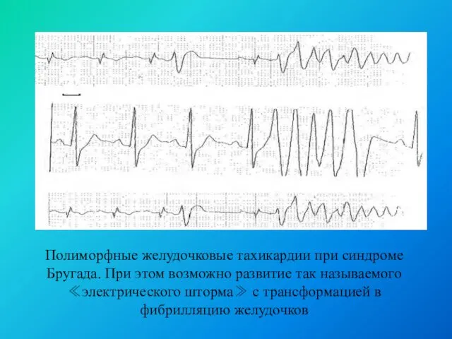 Полиморфные желудочковые тахикардии при синдроме Бругада. При этом возможно развитие так