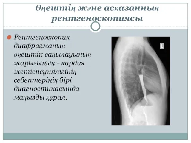 Өңештің және асқазанның рентгеноскопиясы Рентгеноскопия диафрагманың өңештік саңылауының жарығының - кардия