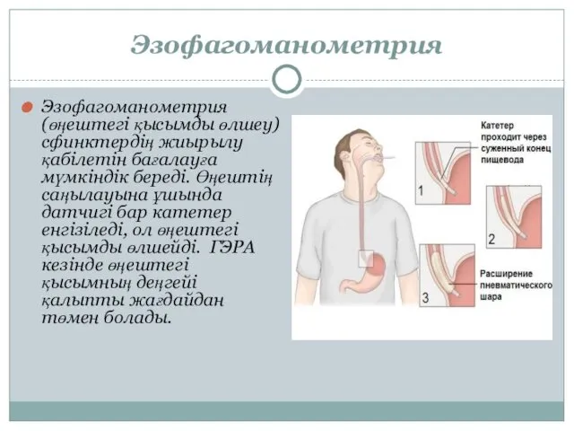 Эзофагоманометрия Эзофагоманометрия (өңештегі қысымды өлшеу) сфинктердің жиырылу қабілетін бағалауға мүмкіндік береді.