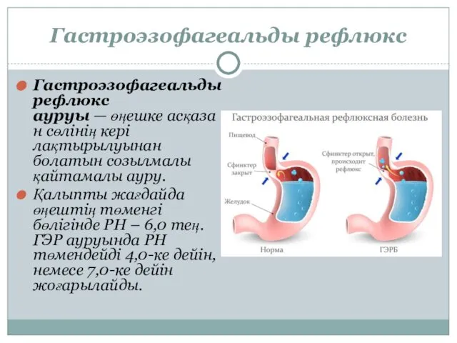 Гастроэзофагеальды рефлюкс Гастроэзофагеальды рефлюкс ауруы — өңешке асқазан сөлінің кері лақтырылуынан