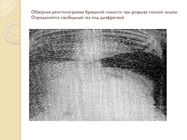 Обзорная рентгенограмма брюшной полости при разрыве тонкой кишки. Определяется свободный газ под диафрагмой