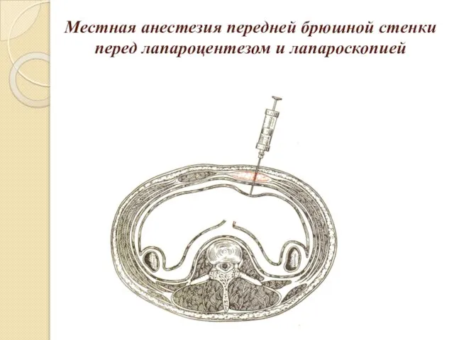 Местная анестезия передней брюшной стенки перед лапароцентезом и лапароскопией