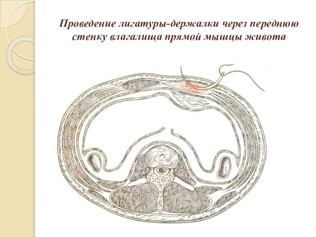 Проведение лигатуры-держалки через переднюю стенку влагалища прямой мышцы живота