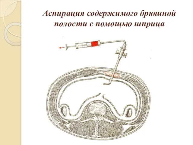 Аспирация содержимого брюшной полости с помощью шприца