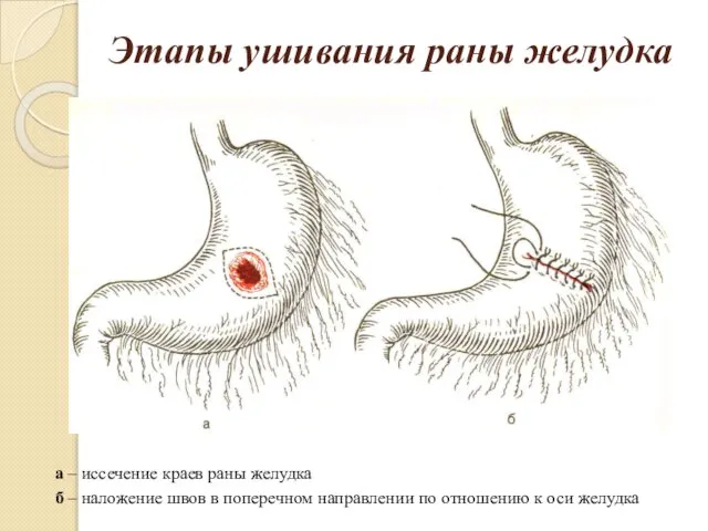 Этапы ушивания раны желудка а – иссечение краев раны желудка б