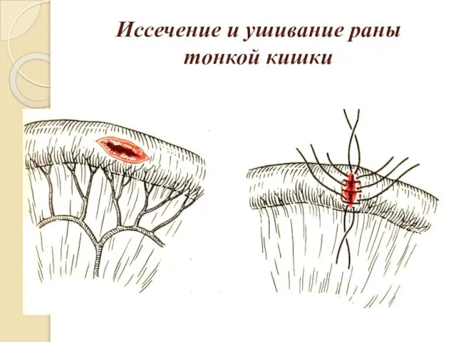 Иссечение и ушивание раны тонкой кишки