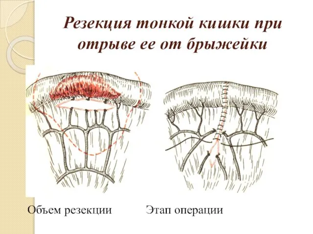 Резекция тонкой кишки при отрыве ее от брыжейки Объем резекции Этап операции