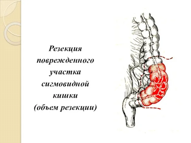 Резекция поврежденного участка сигмовидной кишки (объем резекции)