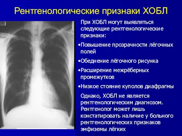 Рентгенологические признаки ХОБЛ При ХОБЛ могут выявляться следующие рентгенологические признаки: Повышение