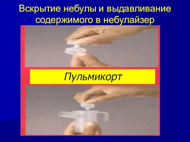 Вскрытие небулы и выдавливание содержимого в небулайзер Пульмикорт