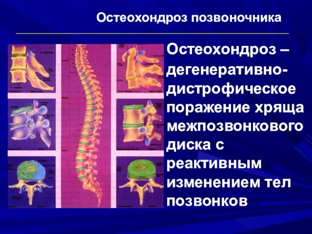 Остеохондроз позвоночника Остеохондроз – дегенеративно-дистрофическое поражение хряща межпозвонкового диска с реактивным изменением тел позвонков