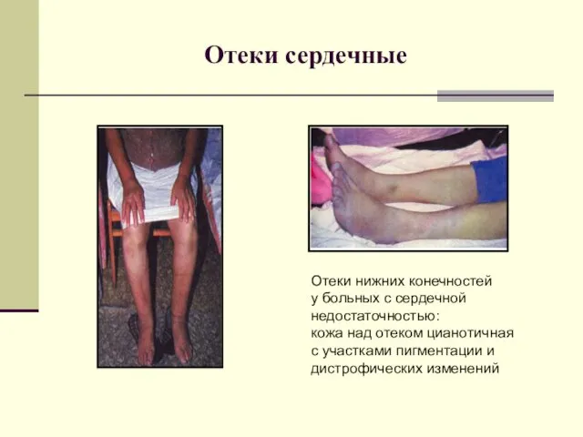 Отеки сердечные Отеки нижних конечностей у больных с сердечной недостаточностью: кожа