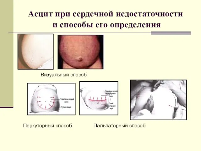 Асцит при сердечной недостаточности и способы его определения Перкуторный способ Пальпаторный способ Визуальный способ