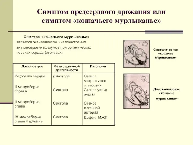 Симптом предсердного дрожания или симптом «кошачьего мурлыканье» Симптом «кошачьего мурлыканье» является