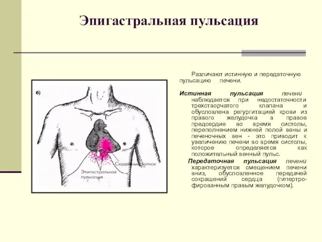 Эпигастральная пульсация Различают истинную и передаточную пульсацию печени. Истинная пульсация печени