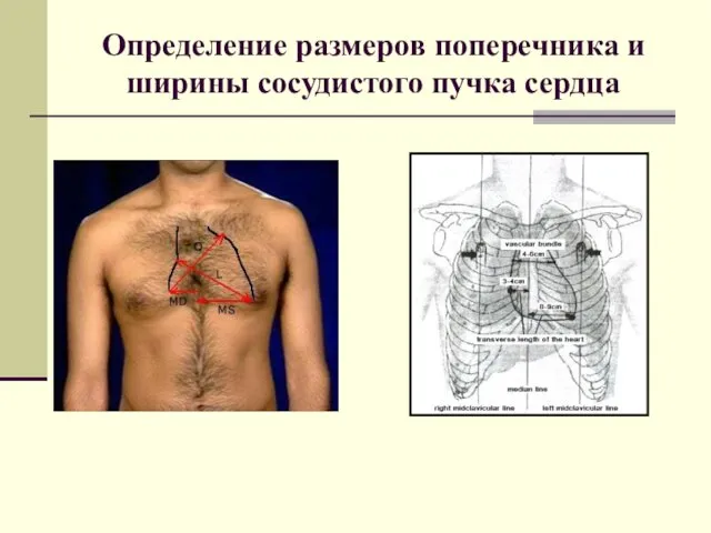 Определение размеров поперечника и ширины сосудистого пучка сердца