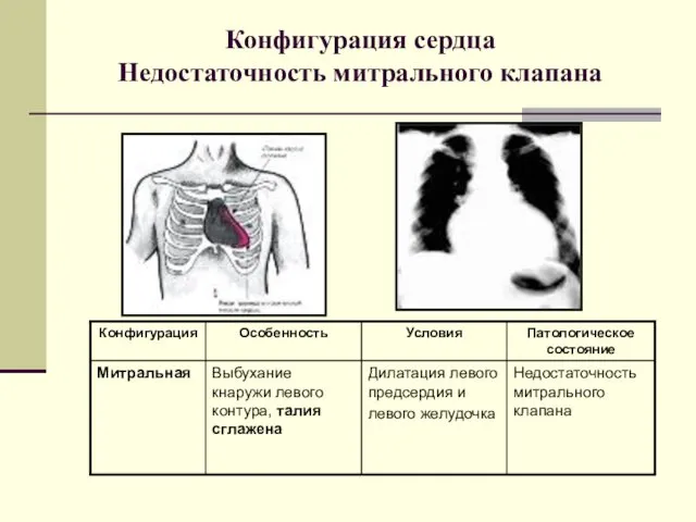 Конфигурация сердца Недостаточность митрального клапана