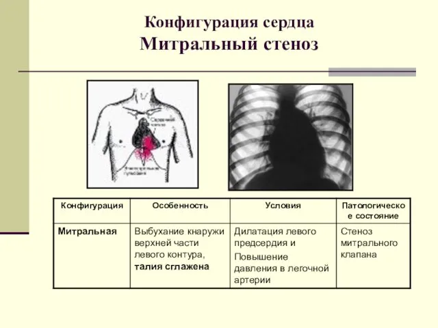 Конфигурация сердца Митральный стеноз