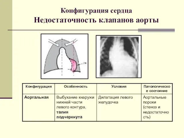 Конфигурация сердца Недостаточность клапанов аорты