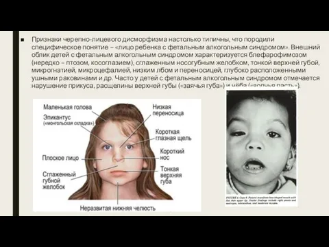 Признаки черепно-лицевого дисморфизма настолько типичны, что породили специфическое понятие – «лицо