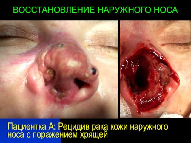 Пациентка А: Рецидив рака кожи наружного носа с поражением хрящей ВОССТАНОВЛЕНИЕ НАРУЖНОГО НОСА