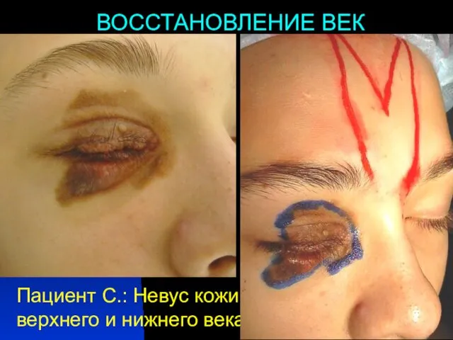 ВОССТАНОВЛЕНИЕ ВЕК Пациент С.: Невус кожи верхнего и нижнего века