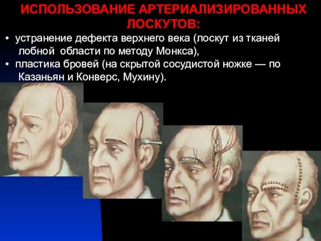 ИСПОЛЬЗОВАНИЕ АРТЕРИАЛИЗИРОВАННЫХ ЛОСКУТОВ: устранение дефекта верхнего века (лоскут из тканей лобной