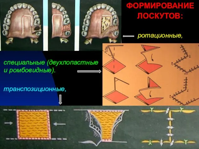 ФОРМИРОВАНИЕ ЛОСКУТОВ: ротационные, транспозиционные, специальные (двухлопастные и ромбовидные).