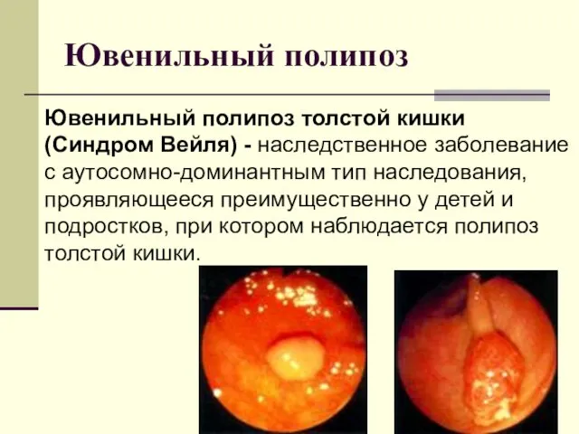 Ювенильный полипоз Ювенильный полипоз толстой кишки (Синдром Вейля) - наследственное заболевание