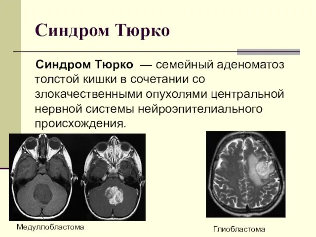 Синдром Тюрко Синдром Тюрко — семейный аденоматоз толстой кишки в сочетании