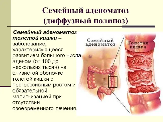 Семейный аденоматоз (диффузный полипоз) Семейный аденоматоз толстой кишки – заболевание, характеризующееся