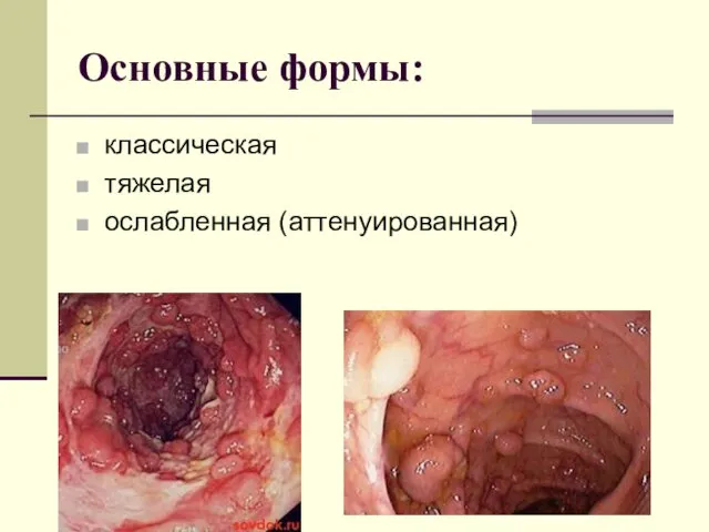 Основные формы: классическая тяжелая ослабленная (аттенуированная)