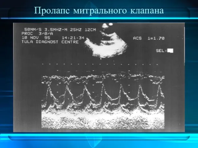 Пролапс митрального клапана