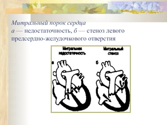 Митральный порок сердца а — недостаточность, б — стеноз левого предсердно-желудочкового отверстия