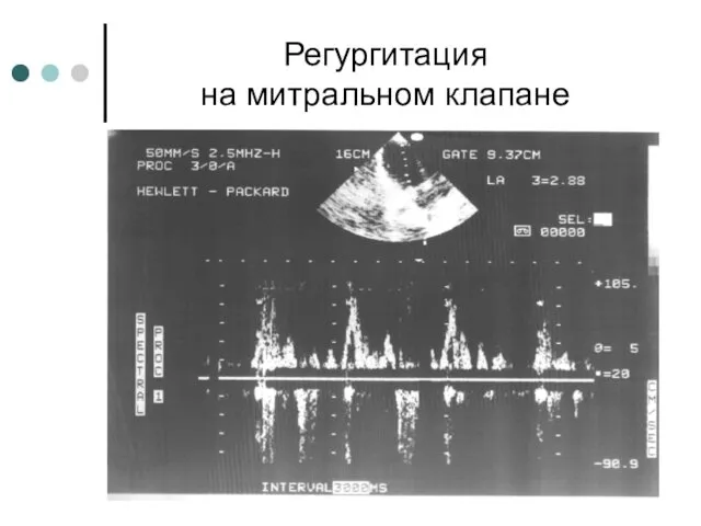 Регургитация на митральном клапане