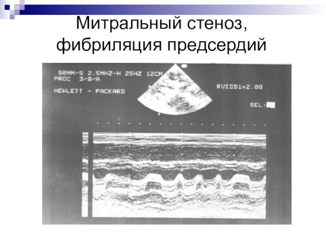 Митральный стеноз, фибриляция предсердий