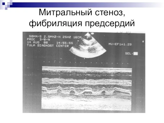 Митральный стеноз, фибриляция предсердий