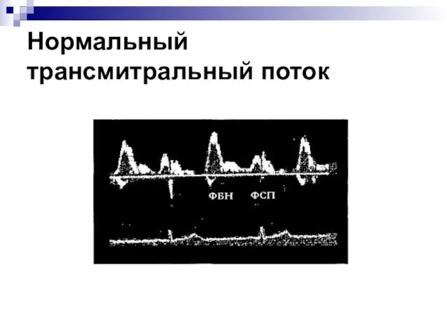 Нормальный трансмитральный поток