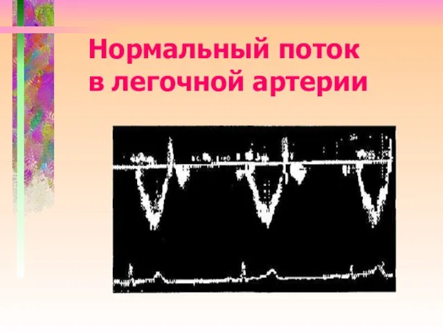 Нормальный поток в легочной артерии