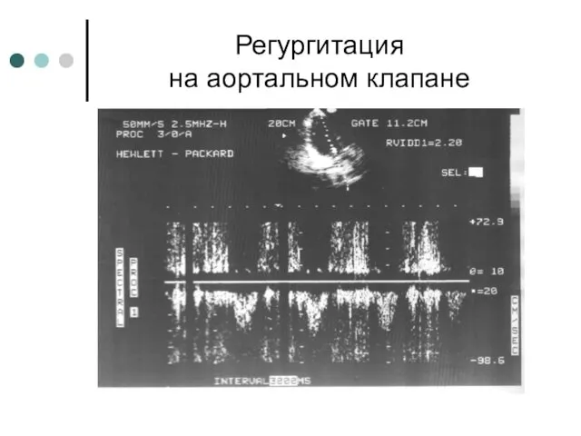 Регургитация на аортальном клапане