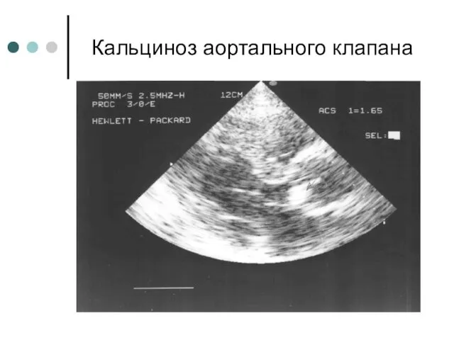 Кальциноз аортального клапана