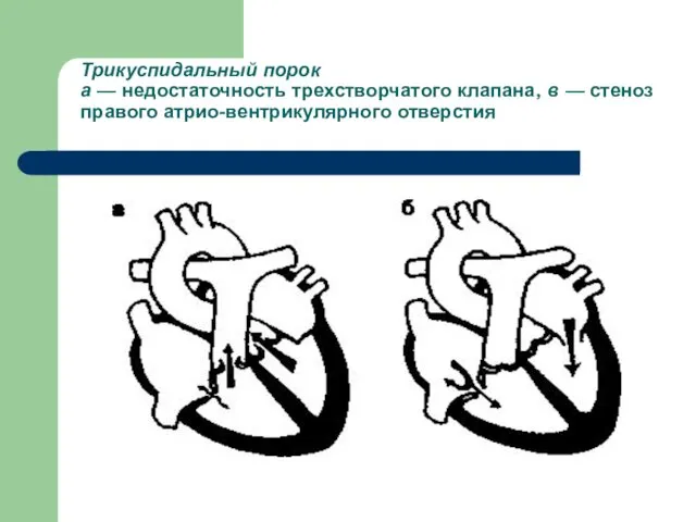 Трикуспидальный порок а — недостаточность трехстворчатого клапана, в — стеноз правого атрио-вентрикулярного отверстия