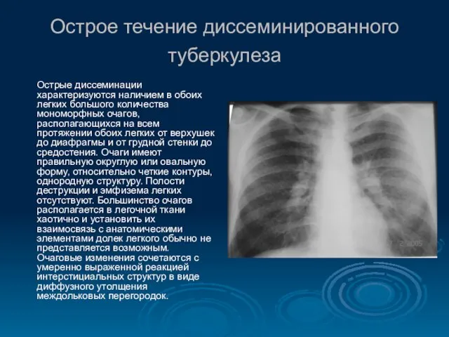 Острое течение диссеминированного туберкулеза Острые диссеминации характеризуются наличием в обоих легких