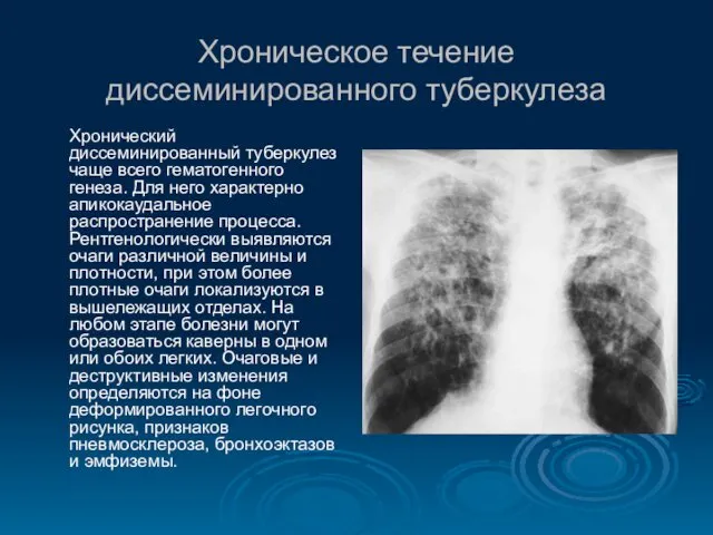Хроническое течение диссеминированного туберкулеза Хронический диссеминированный туберкулез чаще всего гематогенного генеза.