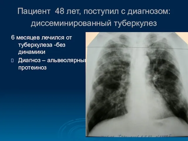 Пациент 48 лет, поступил с диагнозом: диссеминированный туберкулез 6 месяцев лечился