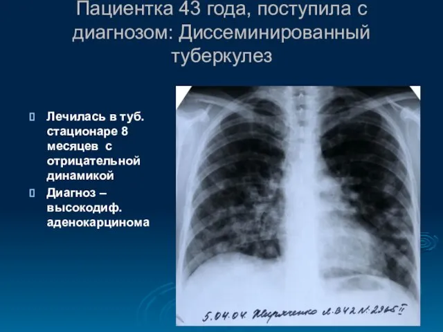 Пациентка 43 года, поступила с диагнозом: Диссеминированный туберкулез Лечилась в туб.