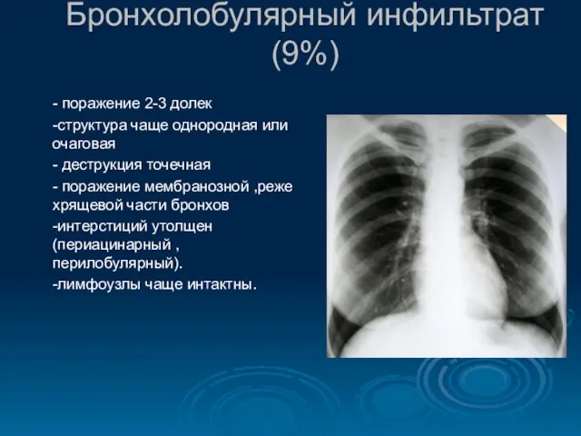 Бронхолобулярный инфильтрат (9%) - поражение 2-3 долек -структура чаще однородная или